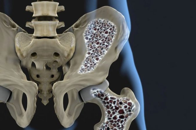 Mencegah Osteoporosis